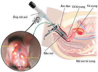 hình ảnh nội soi giúp chẩn đoán lạc nội mạc tử cung