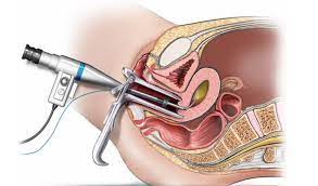 Bác sĩ dùng ống nội soi để thăm dò và nhìn trực tiếp trên màn hình