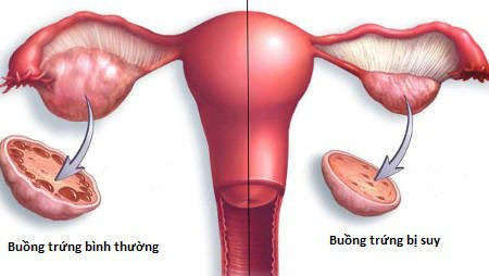 Giảm dự trữ buồng trứng: nguyên nhân, chẩn đoán và điều trị