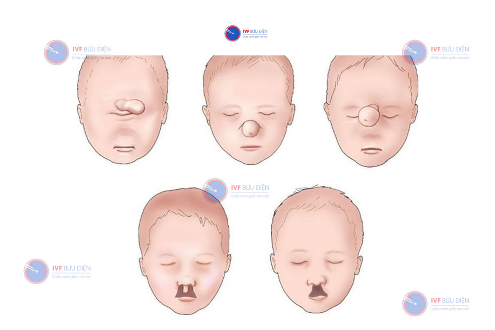 Một số các dị dạng về khuôn mặt cho hội chứng Patau Trisomy 13 thuần gây ra.