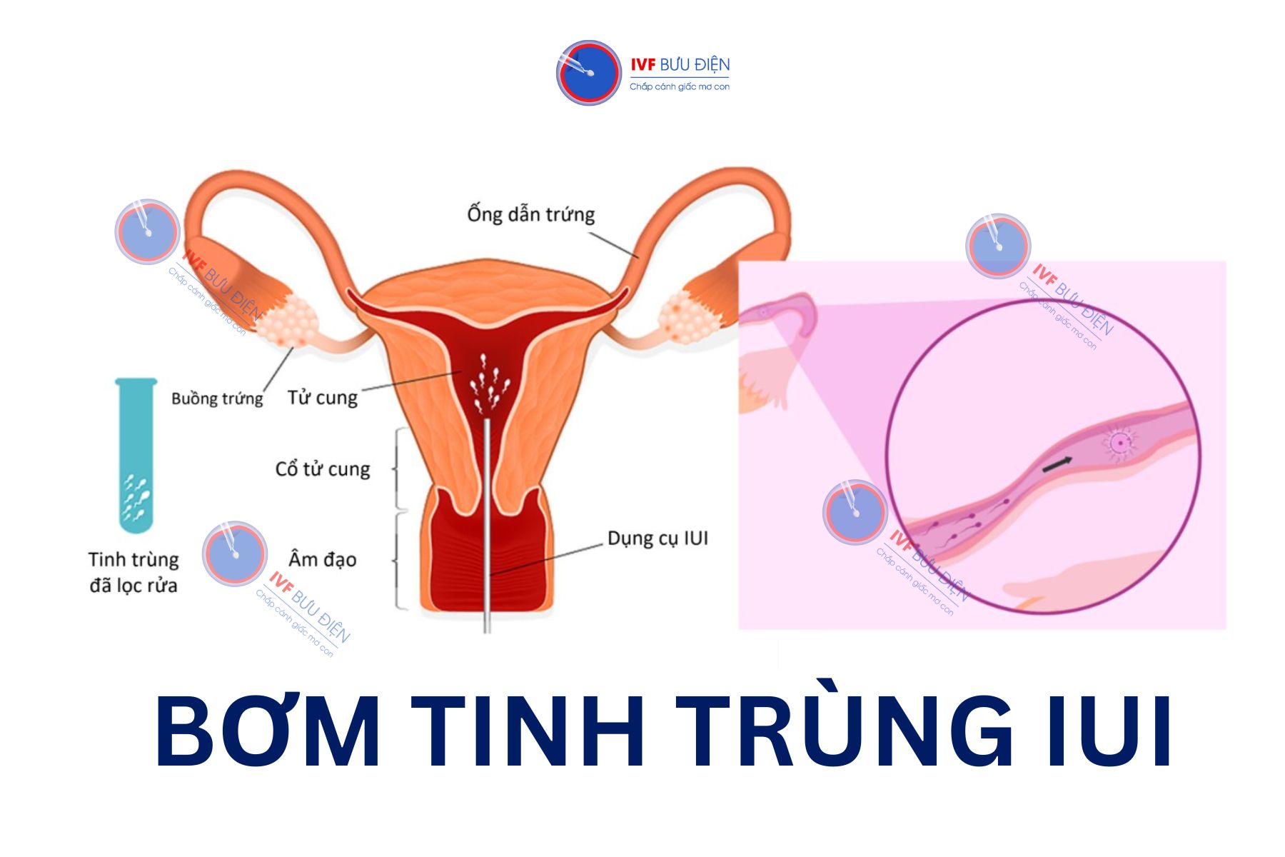 IUI là một trong những phương pháp phổ biến nhất giúp phụ nữ bị đa nang buồng trứng mang thai.