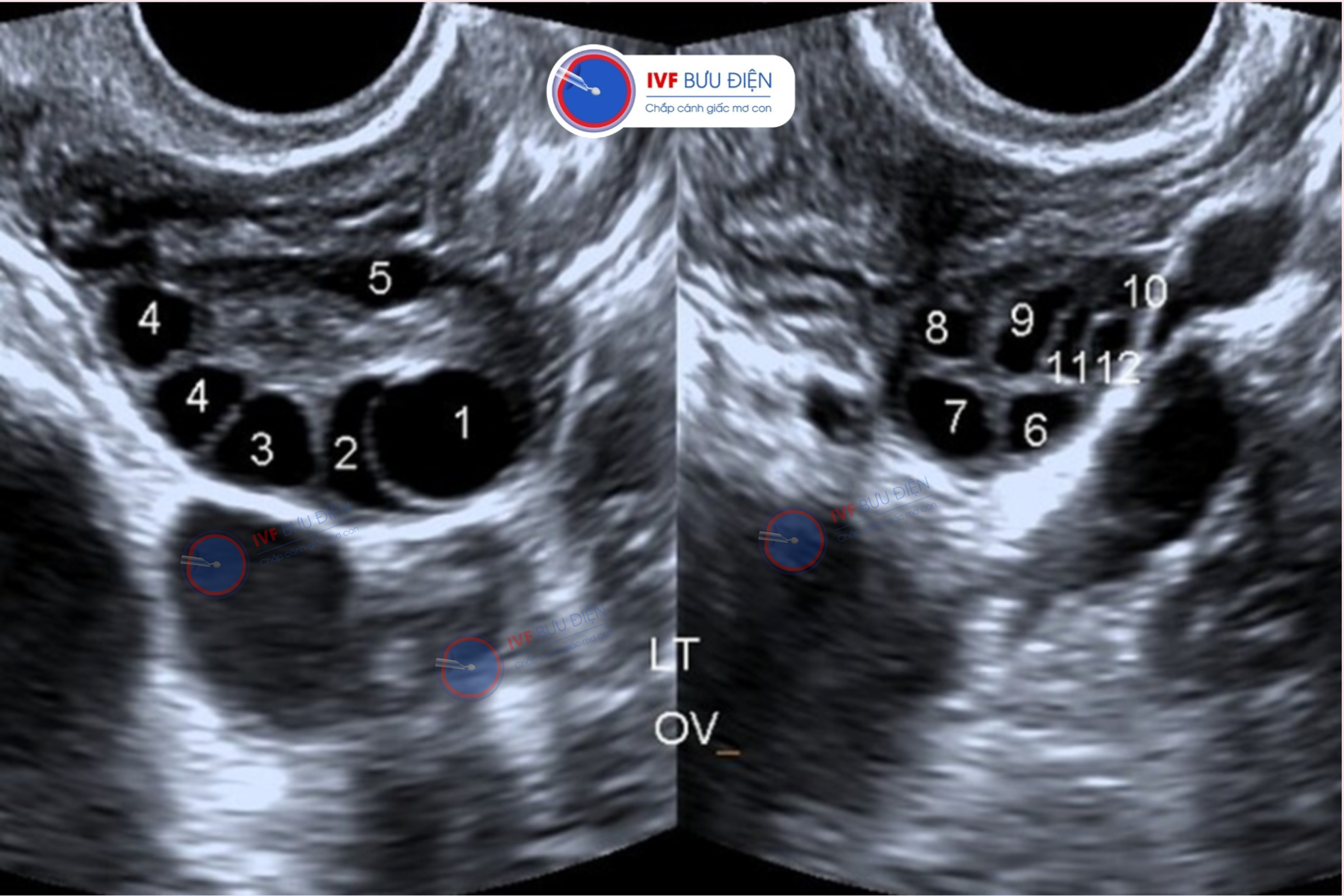 Hình ảnh siêu âm đa nang buồng trứng