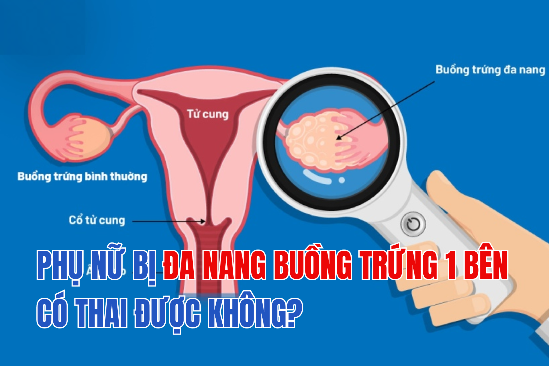 Phụ nữ bị đa nang buồng trứng 1 bên có thai được không?