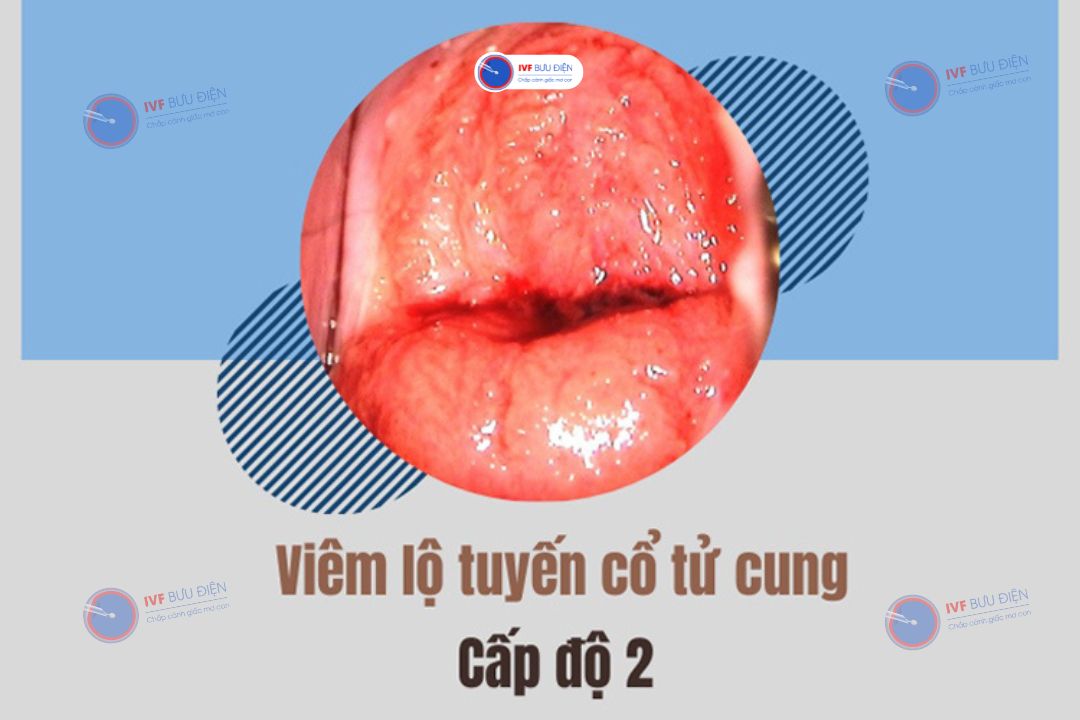 Hình ảnh viêm lộ tuyến cổ tử cung cấp độ 2