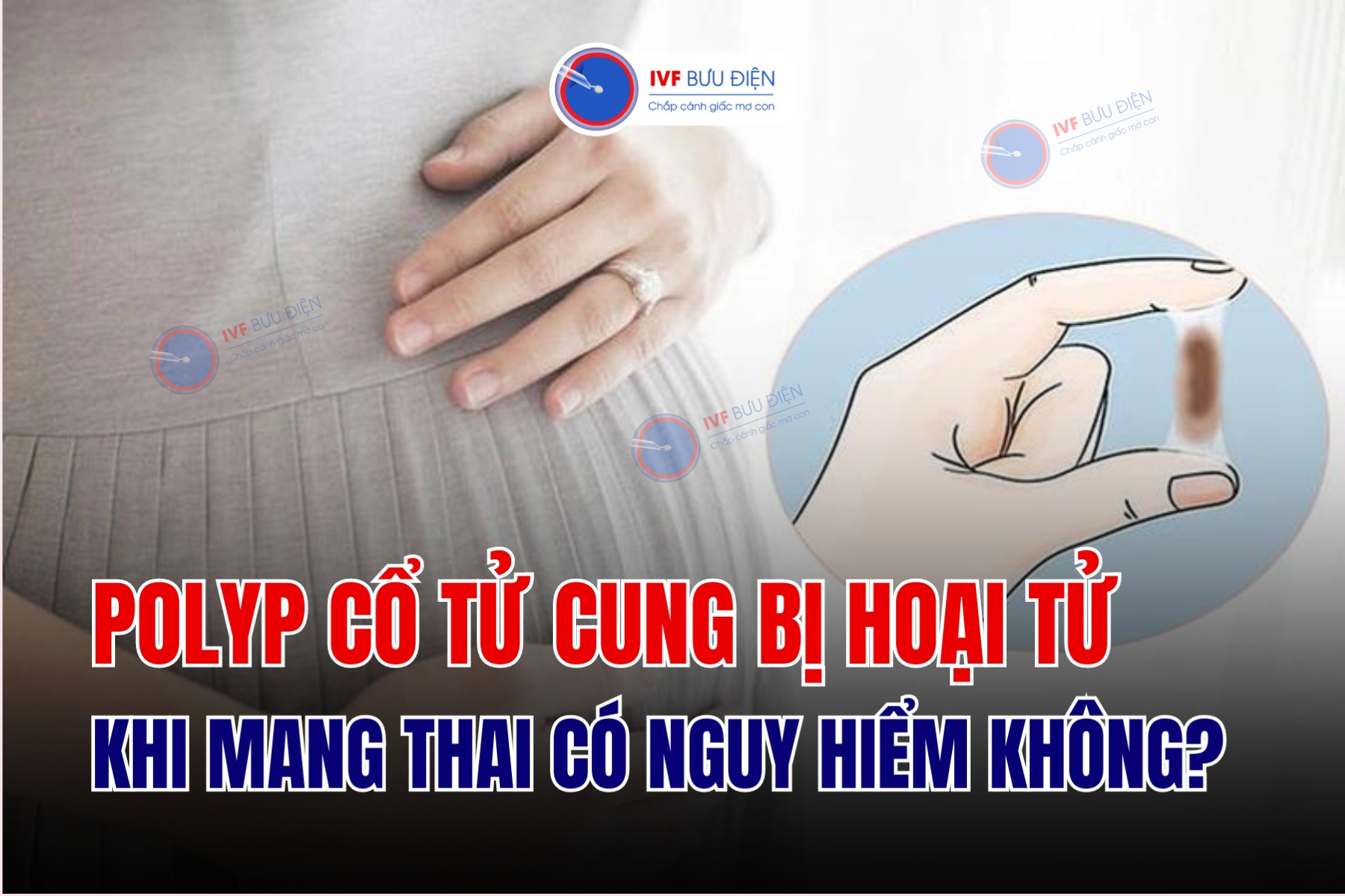 Polyp cổ tử cung bị hoại tử khi mang thai có nguy hiểm không?