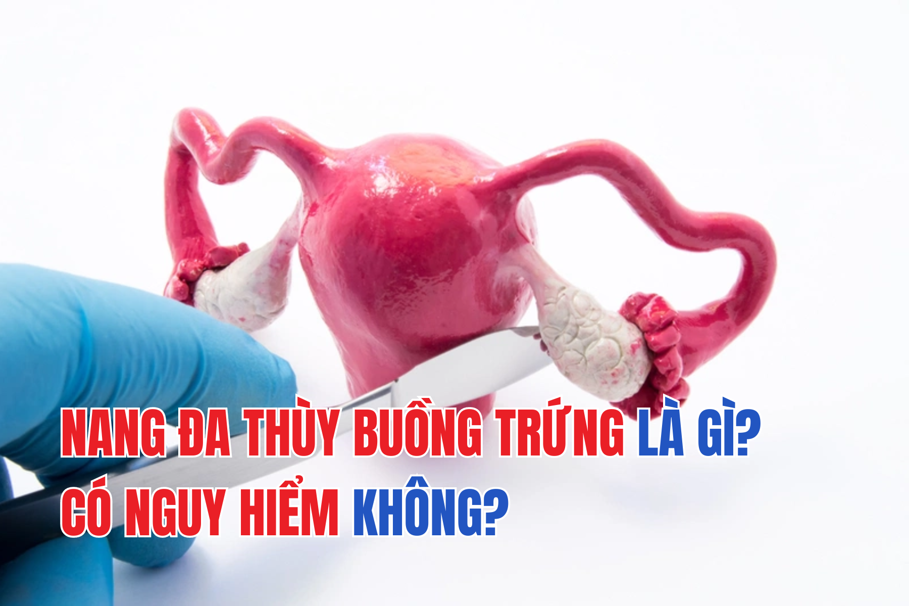 Nang đa thùy buồng trứng là gì? Có nguy hiểm không?