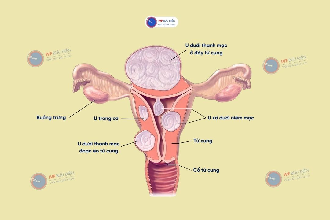 Phân loại U xơ tử cung