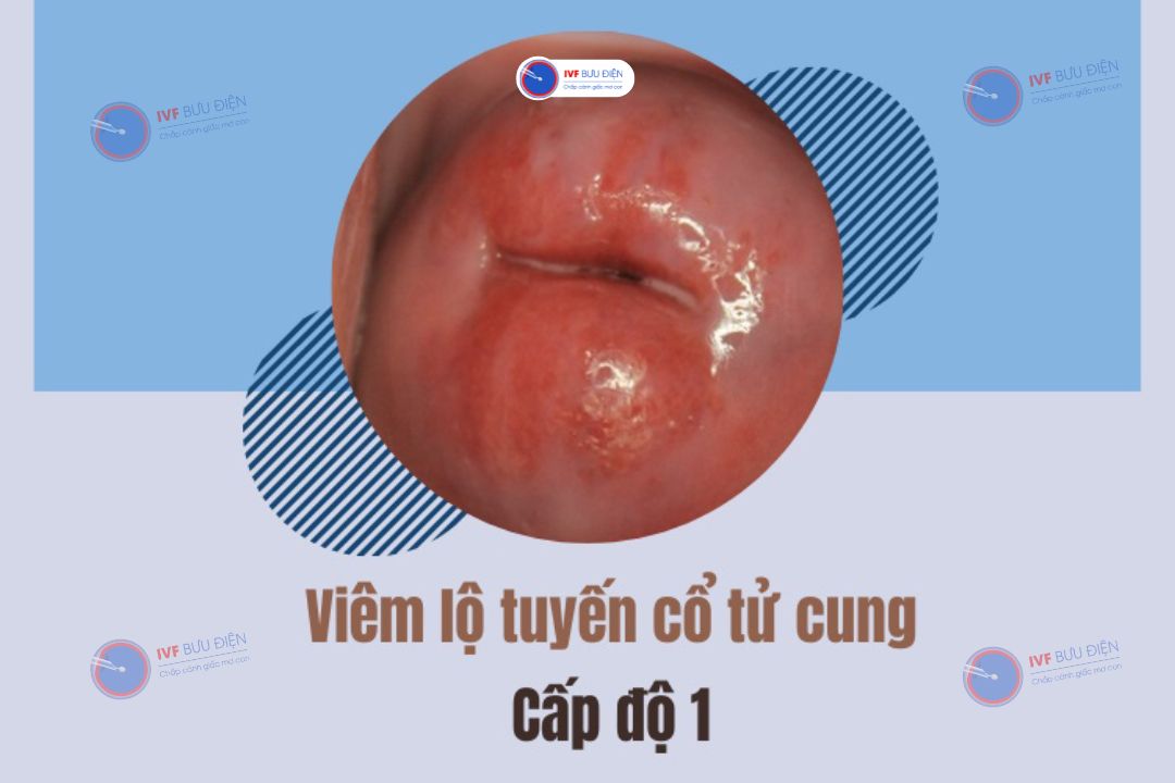 Hình ảnh viêm lộ tuyến cổ tử cung cấp độ 1