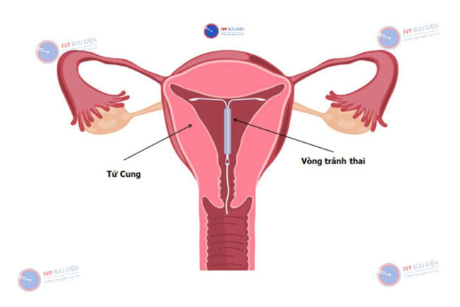 Vòng tránh thai là gì?