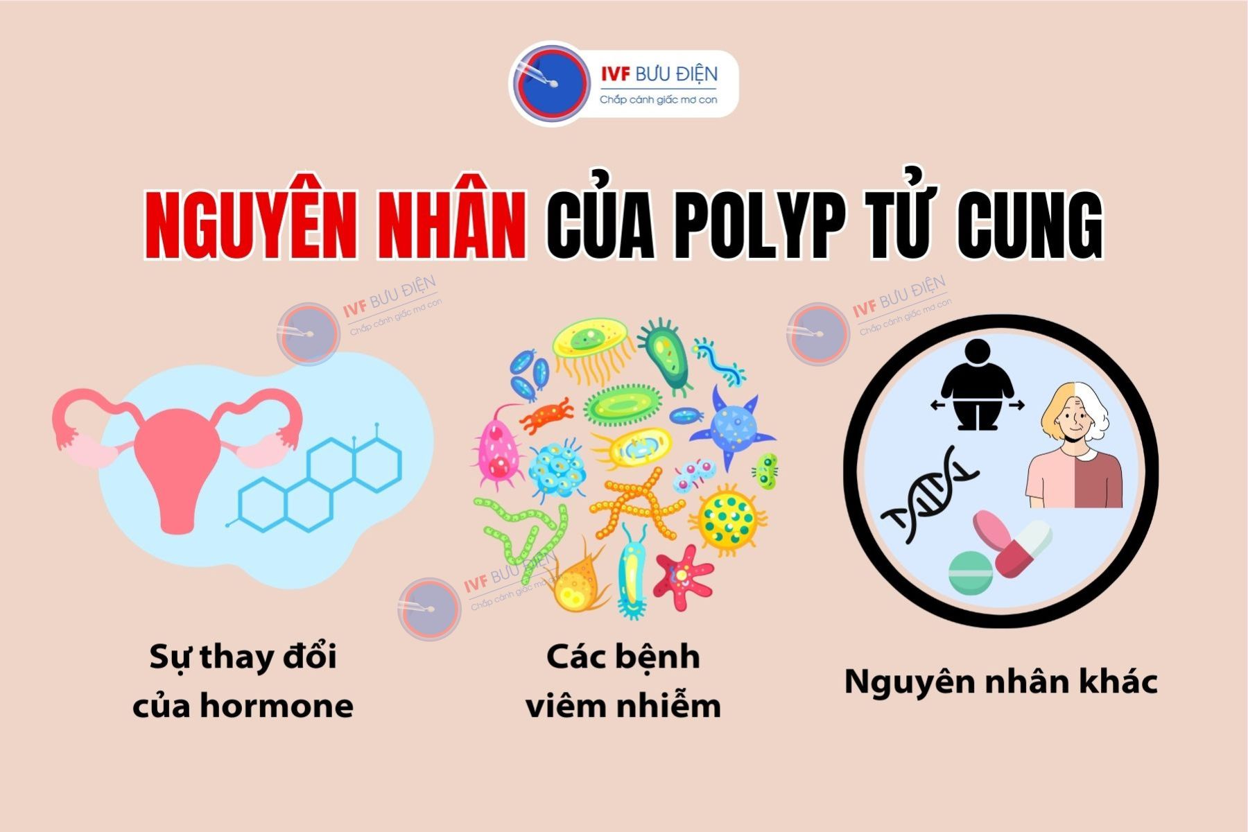 Nguyên nhân gây polyp tử cung