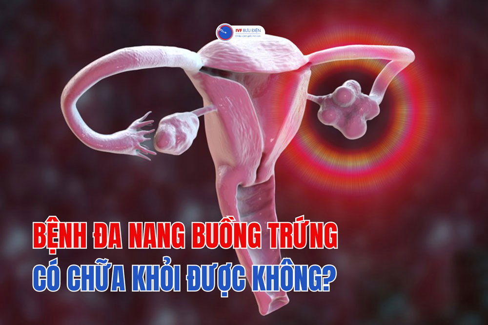 Bệnh đa nang buồng trứng có chữa khỏi được không?