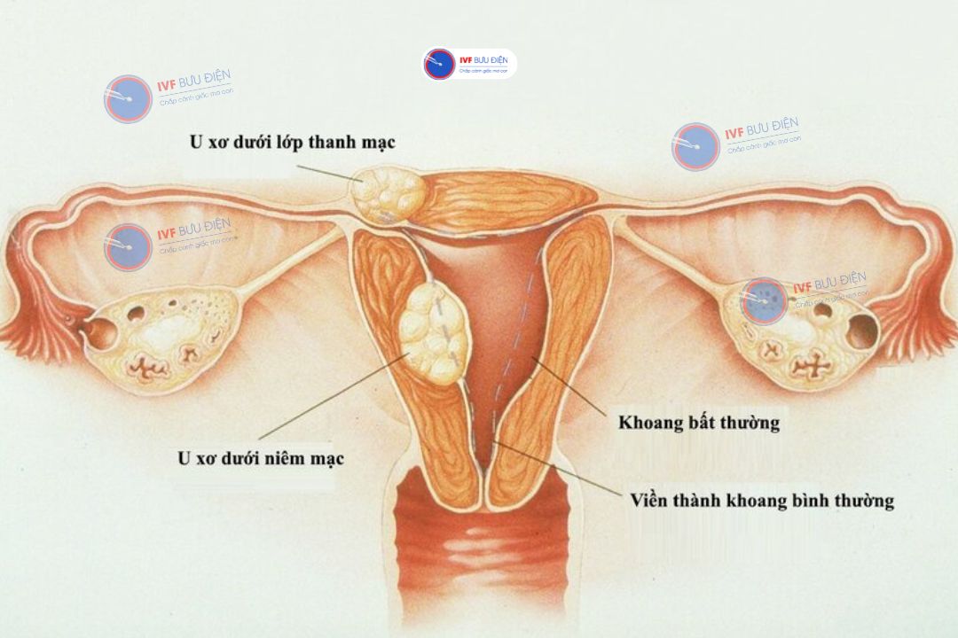 U xơ tử cung là gì?