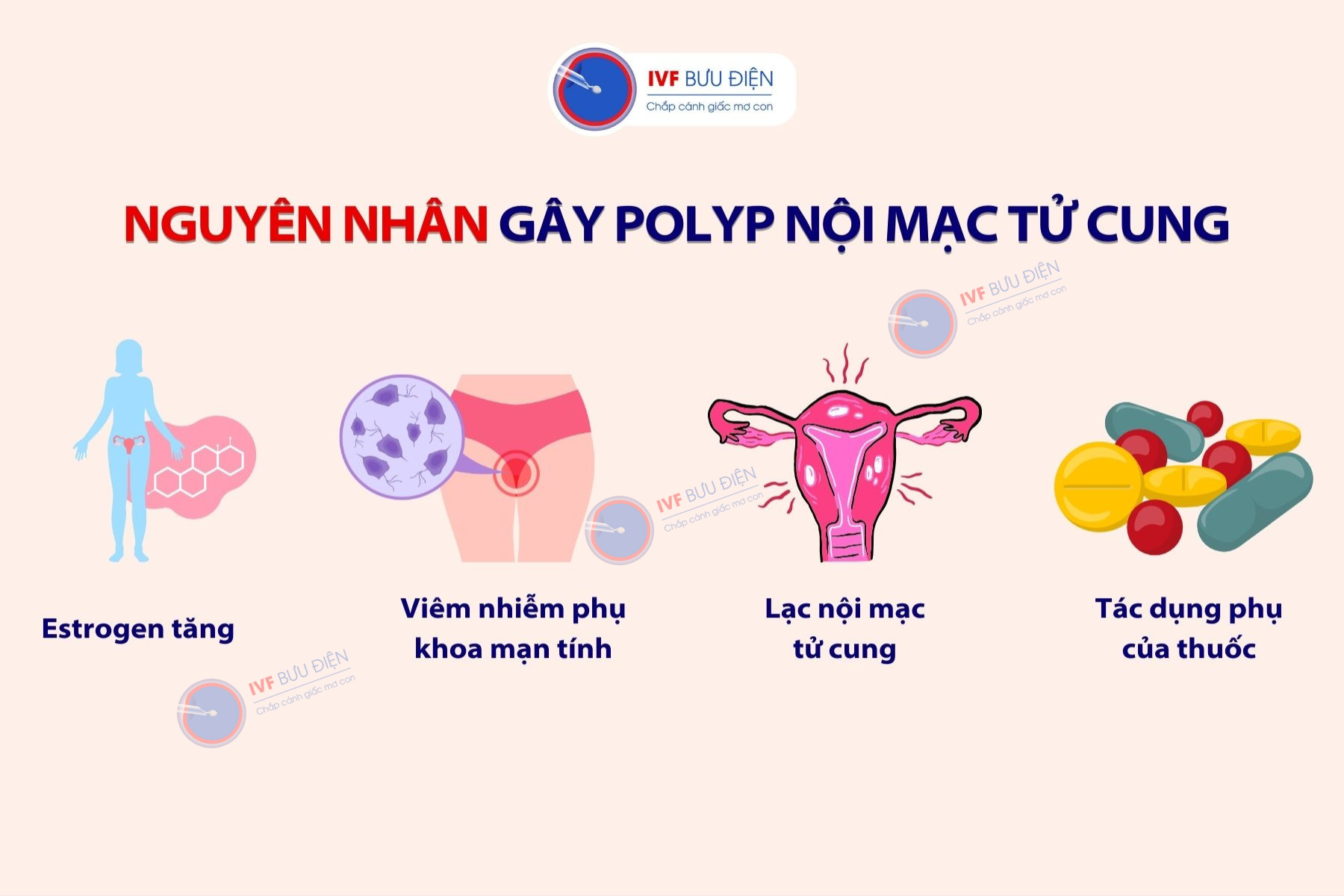 Nguyên nhân gây polyp nội mạc tử cung