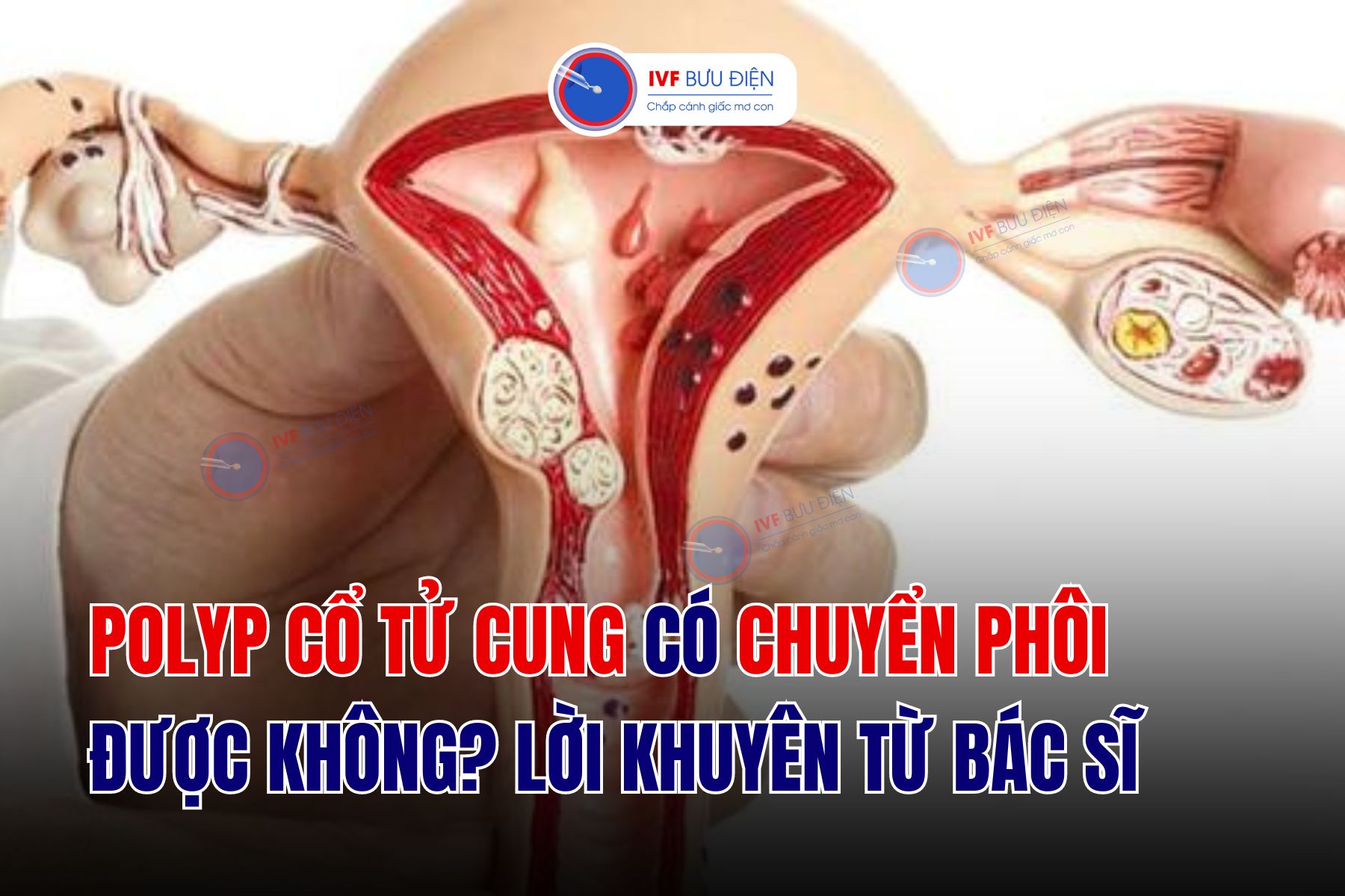 4. Cách chẩn đoán polyp tử cung