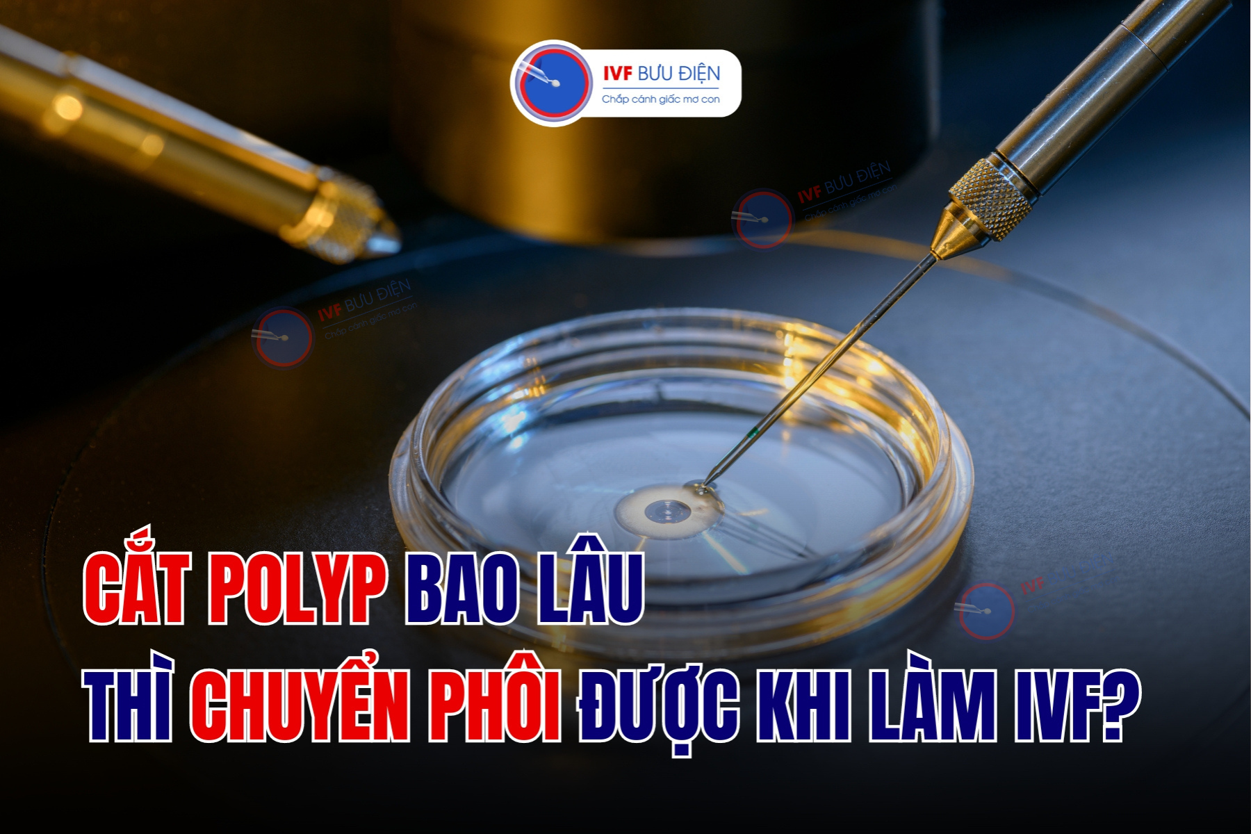 Cắt polyp bao lâu thì chuyển phôi được khi làm IVF?