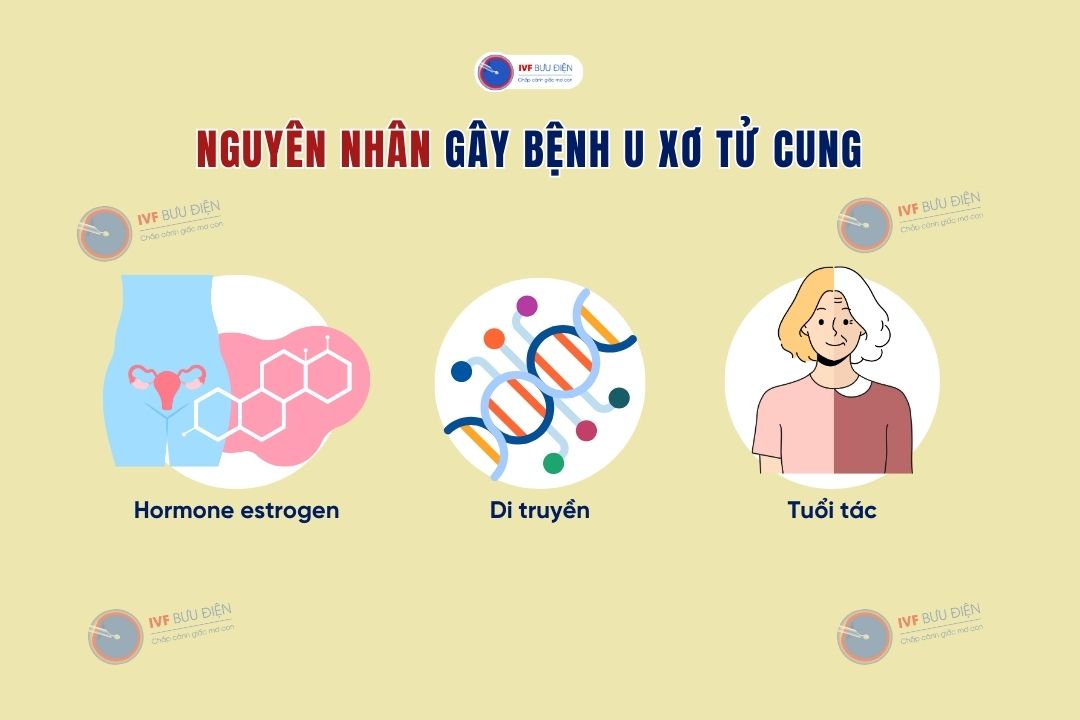 Nguyên nhân gây bệnh u xơ tử cung