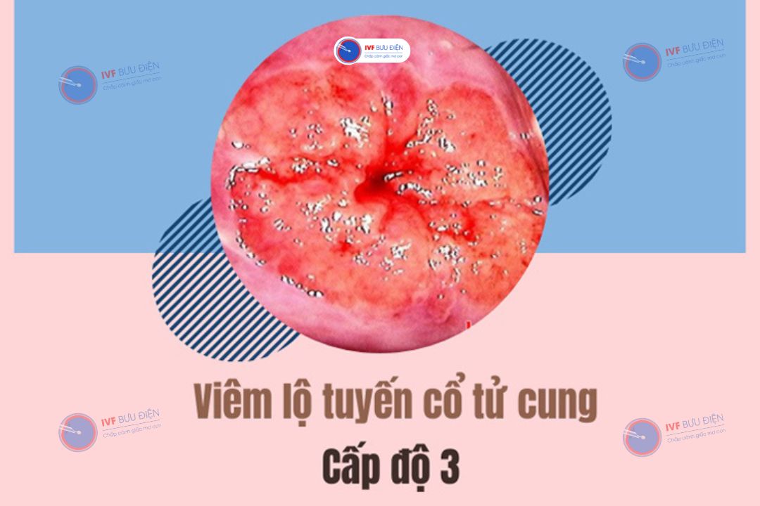 Hình ảnh viêm lộ tuyến cổ tử cung cấp độ 3