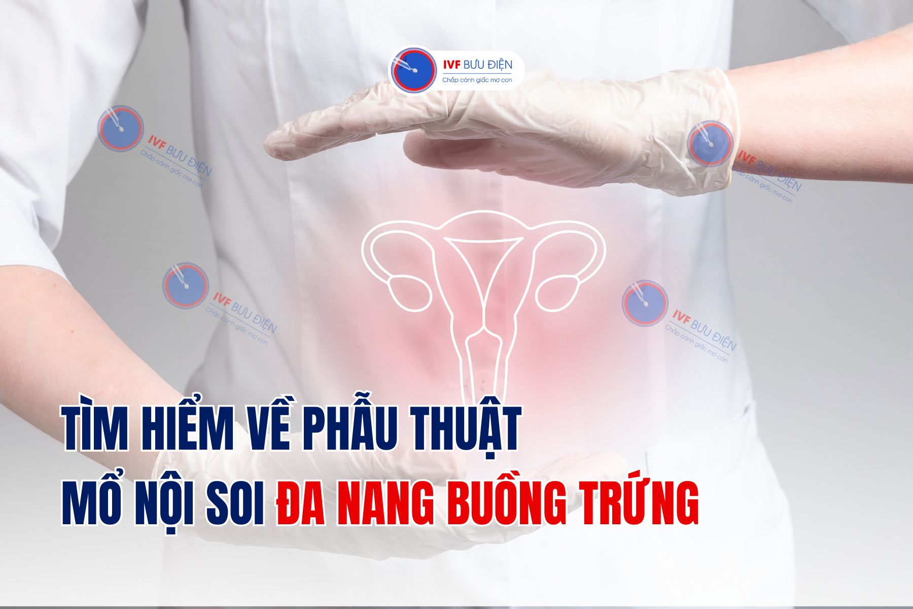 Phẫu thuật mổ nội soi đa nang buồng trứng là gì?