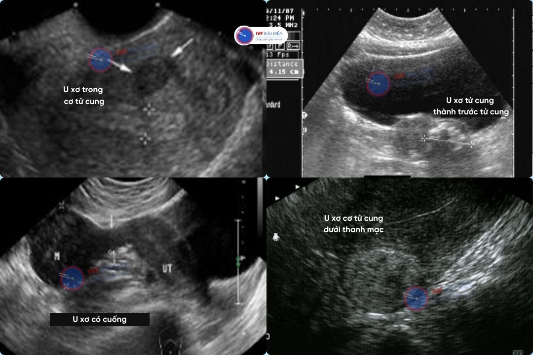 Hình ảnh U xơ tử cung trên siêu âm