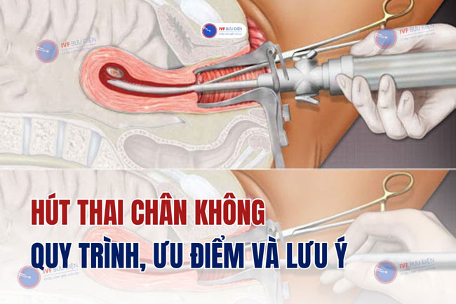 Hút thai chân không: Quy trình, ưu điểm và lưu ý cần biết
