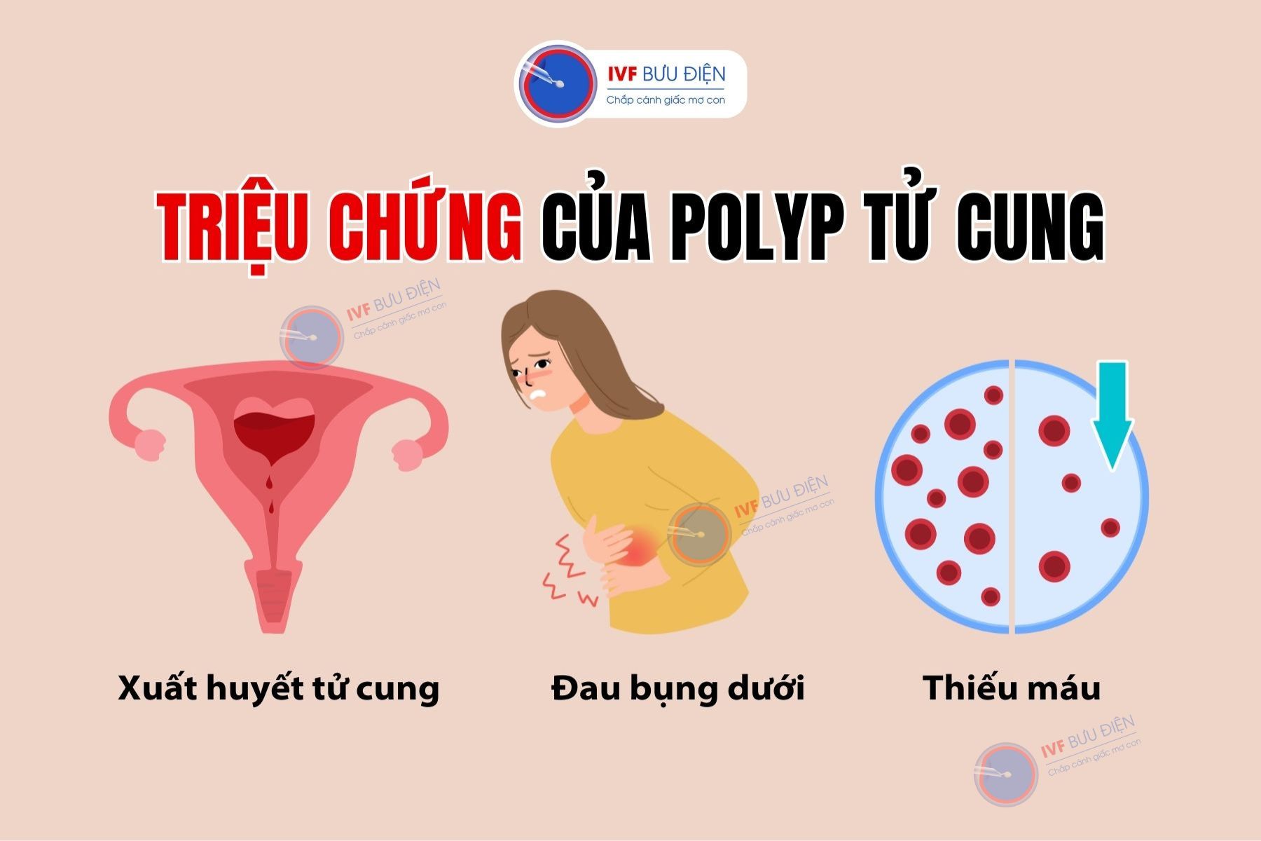 Triệu chứng nổi bật của polyp tử cung