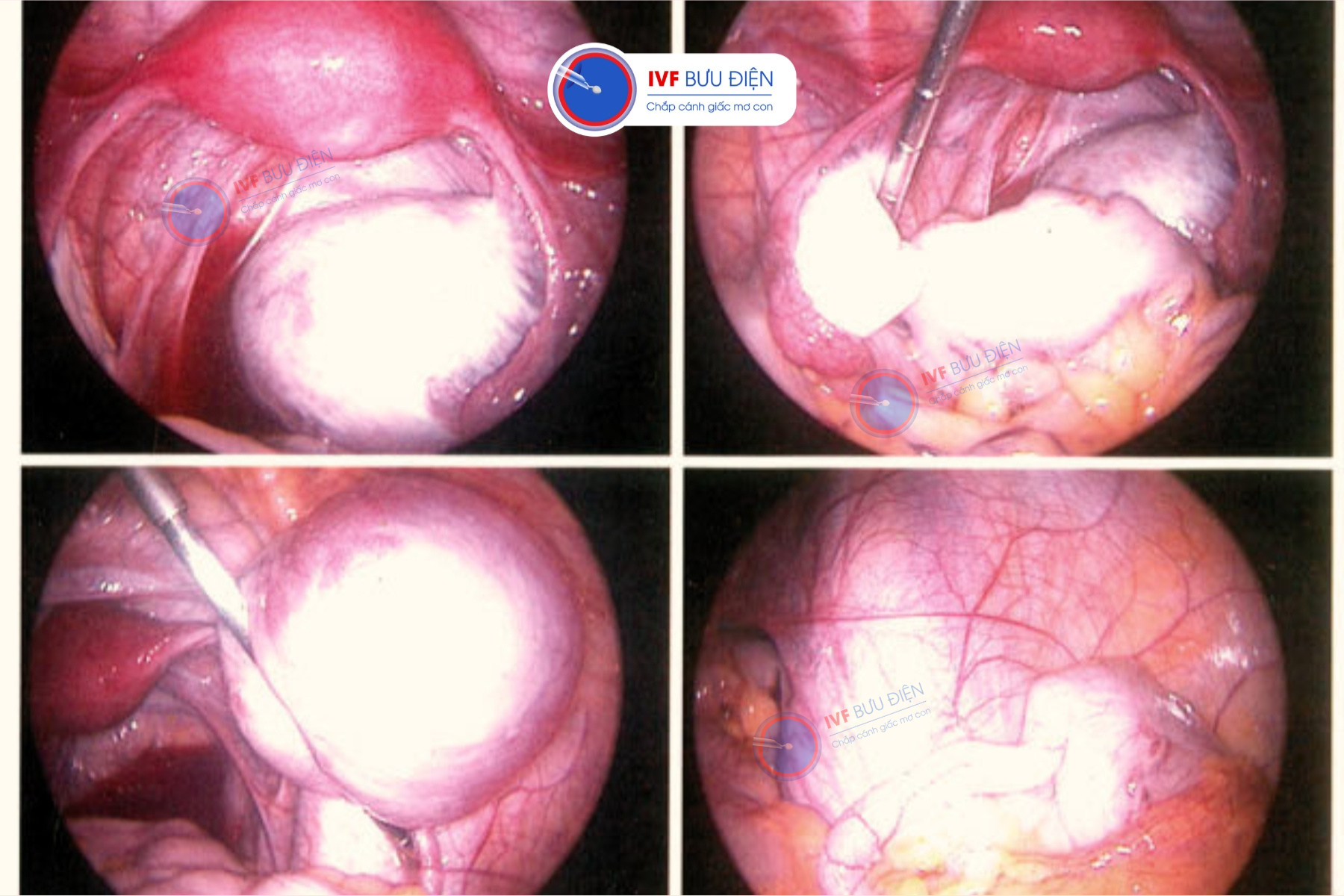 Cắt polyp bao lâu thì chuyển phôi được: Tình trạng nội mạc tử cung là một trong những yếu tố bác sĩ cần kiểm tra trước khi cho phép người bệnh làm IVF