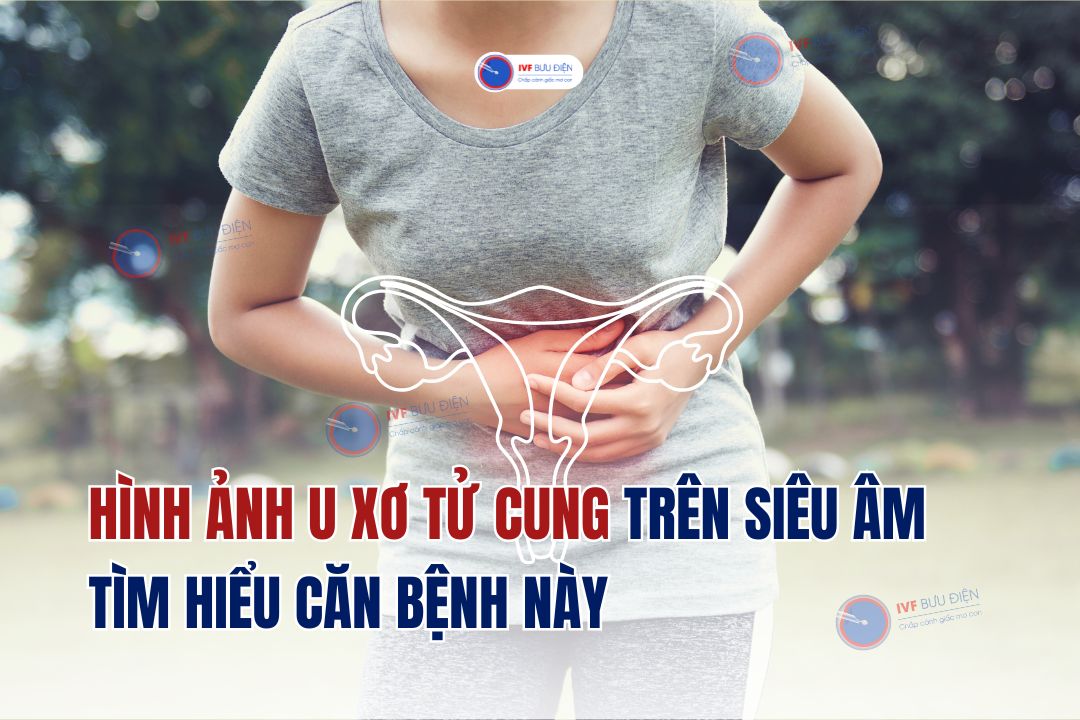 Hình ảnh U xơ tử cung trên siêu âm: Tìm hiểu về căn bệnh này