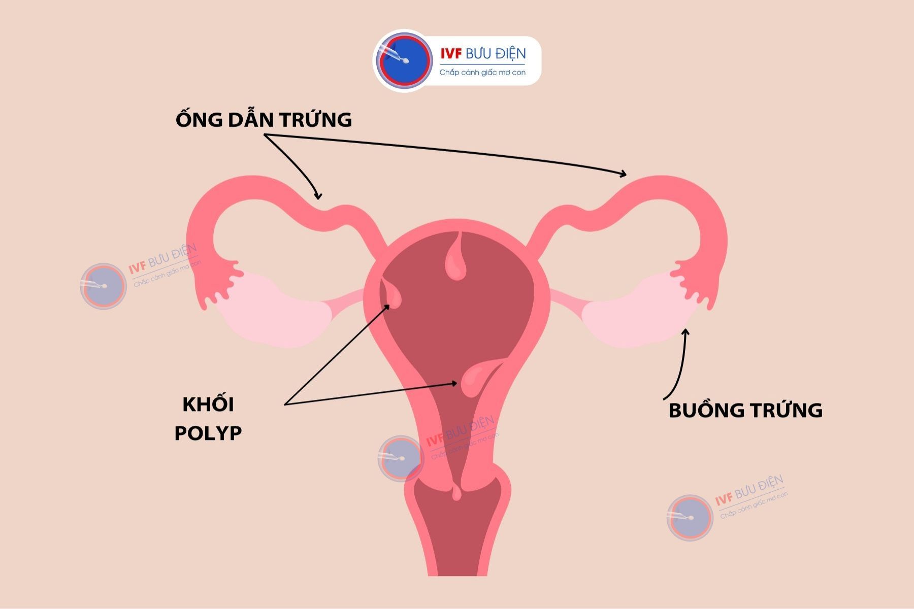 Khối polyp phát triển trong buồng tử cung