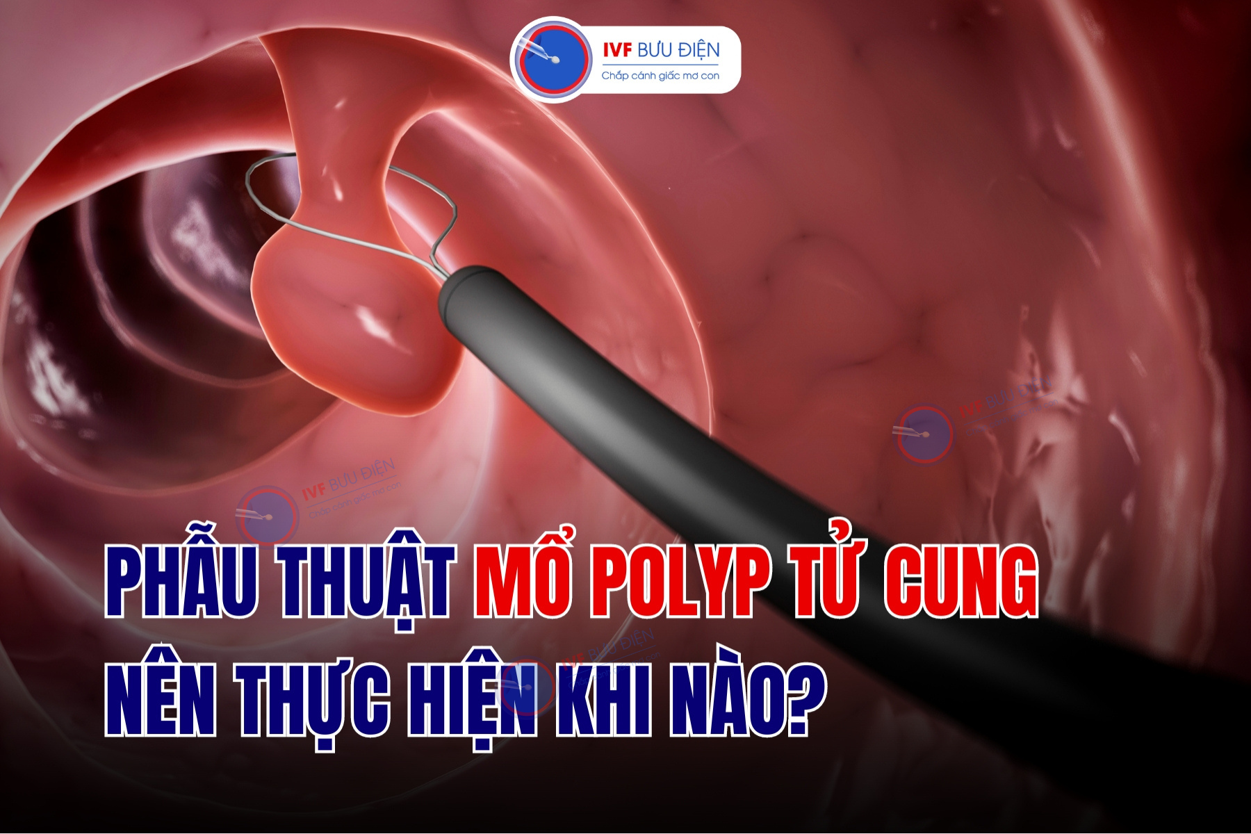 Mổ polyp tử cung nên thực hiện khi nào? 4 trường hợp lưu ý