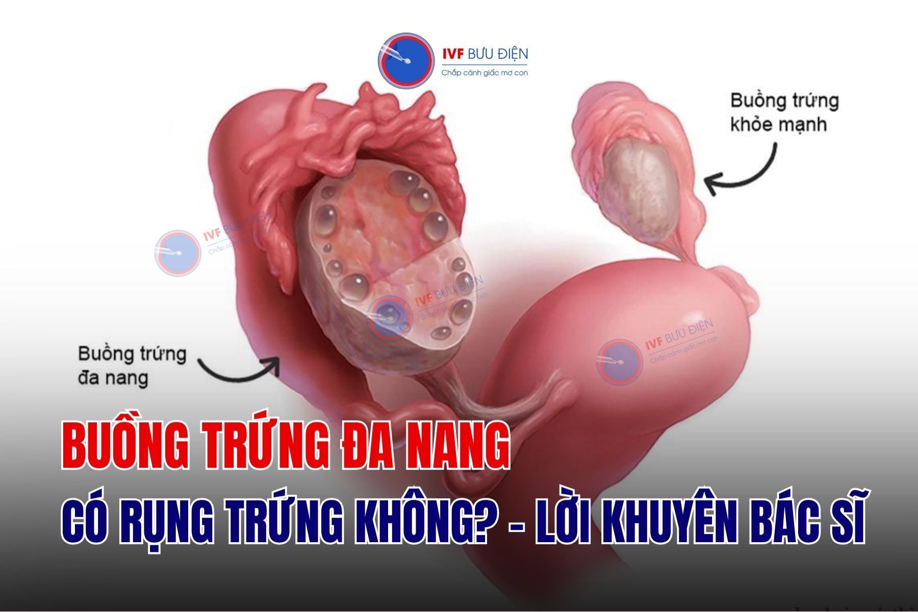 Buồng trứng đa nang có rụng trứng không? 3 dấu hiệu cần biết