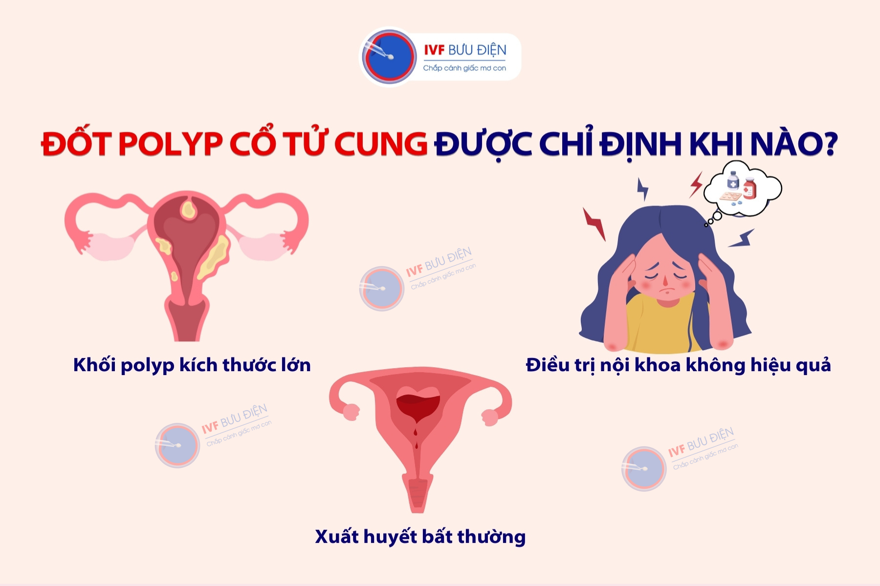 Đốt polyp cổ tử cung: Những trường hợp được thực hiện