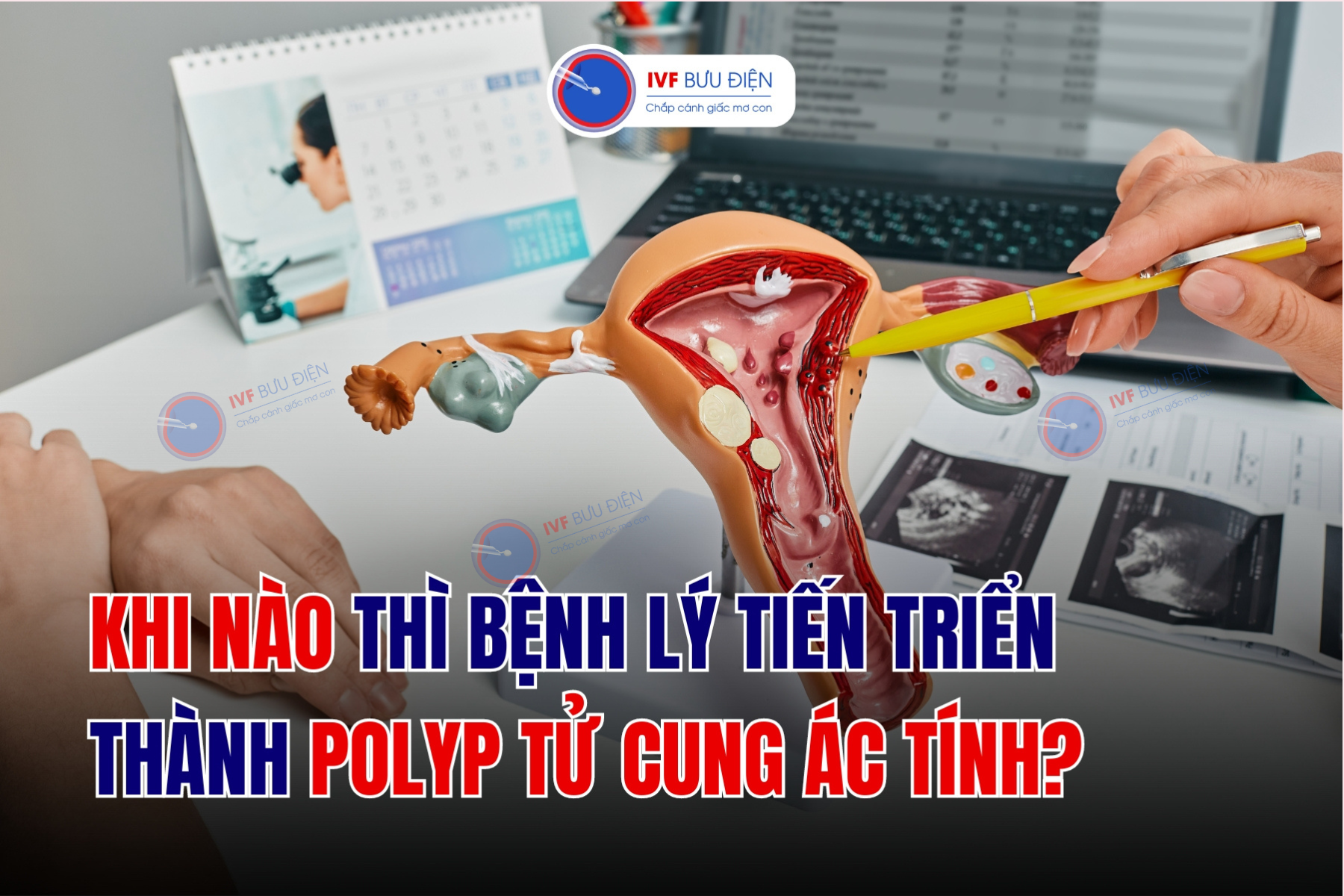 Polyp tử cung ác tính khi nào? 3 cách phòng ngừa hiệu quả