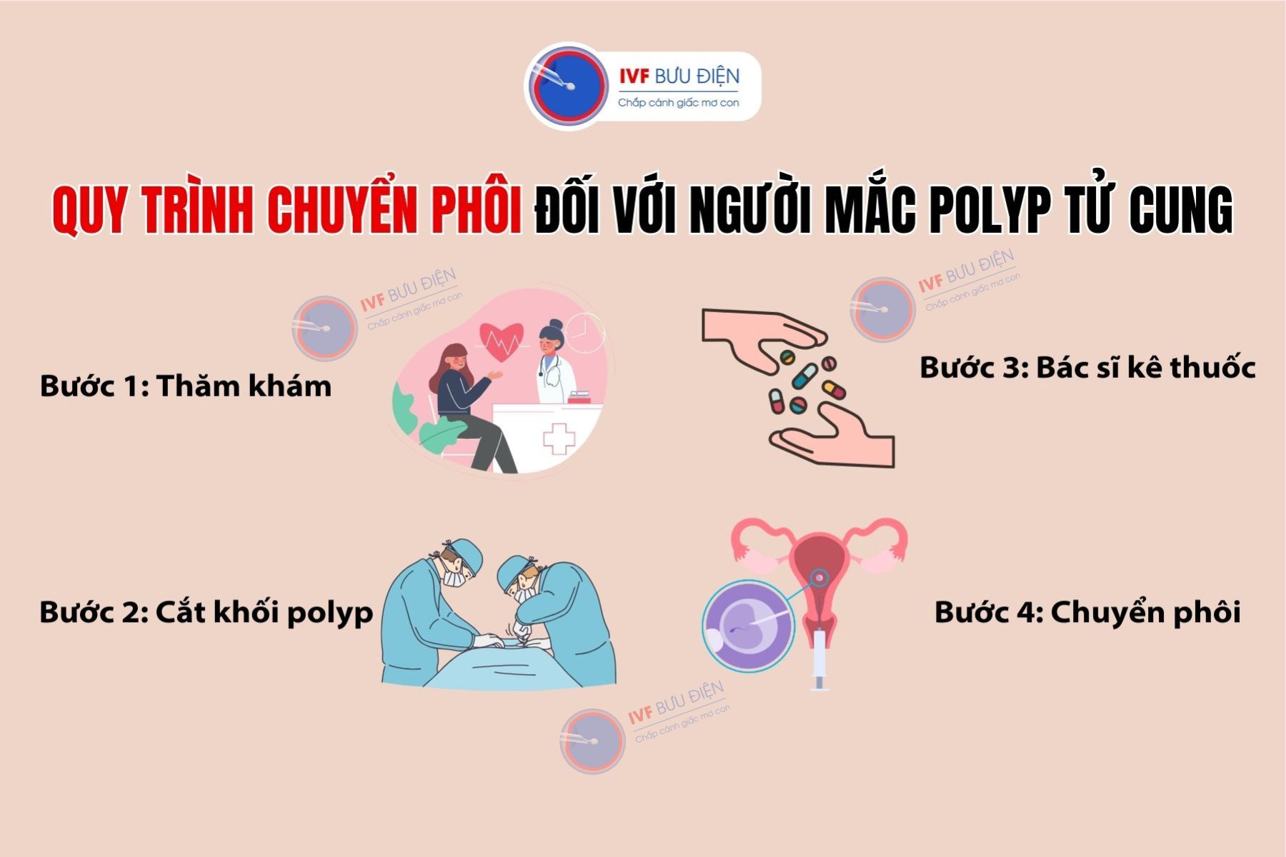 Quy trình chuyển phôi với người mắc polyp tử cung