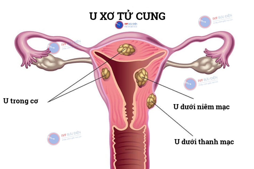 U xơ tử cung là gì