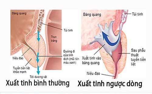 Xuất tinh ngược dòng: nguyên nhân, triệu chứng, tiêu chuẩn chẩn đoán và điều trị