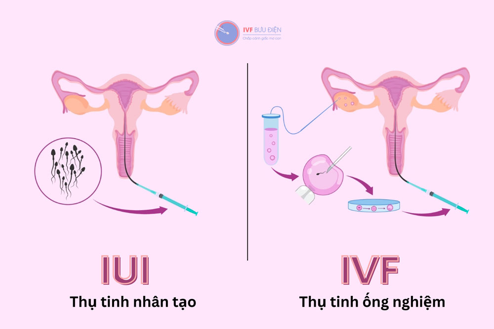 IUI và IVF là gì? Tổng hợp kiến thức chi tiết và hữu ích