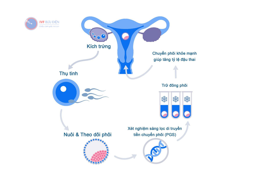 Thực hiện IVF