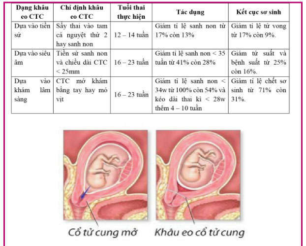 khâu vòng cổ tử cung