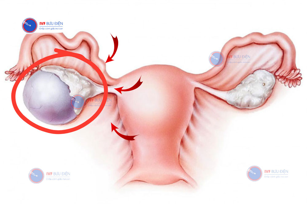 kích thước nang buồng trứng bình thường