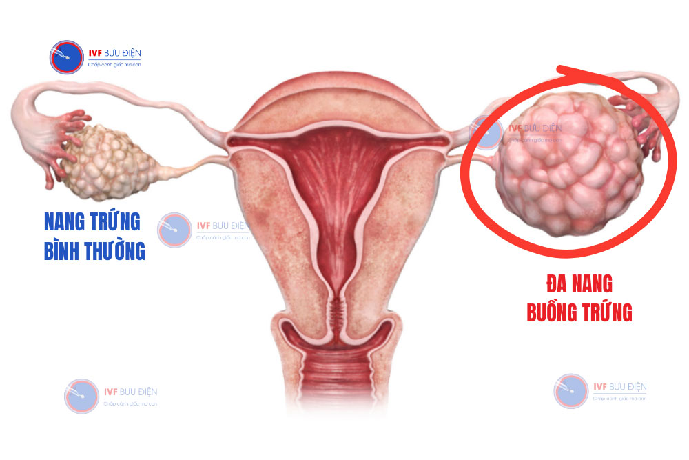 kích thước nang buồng trứng bình thường