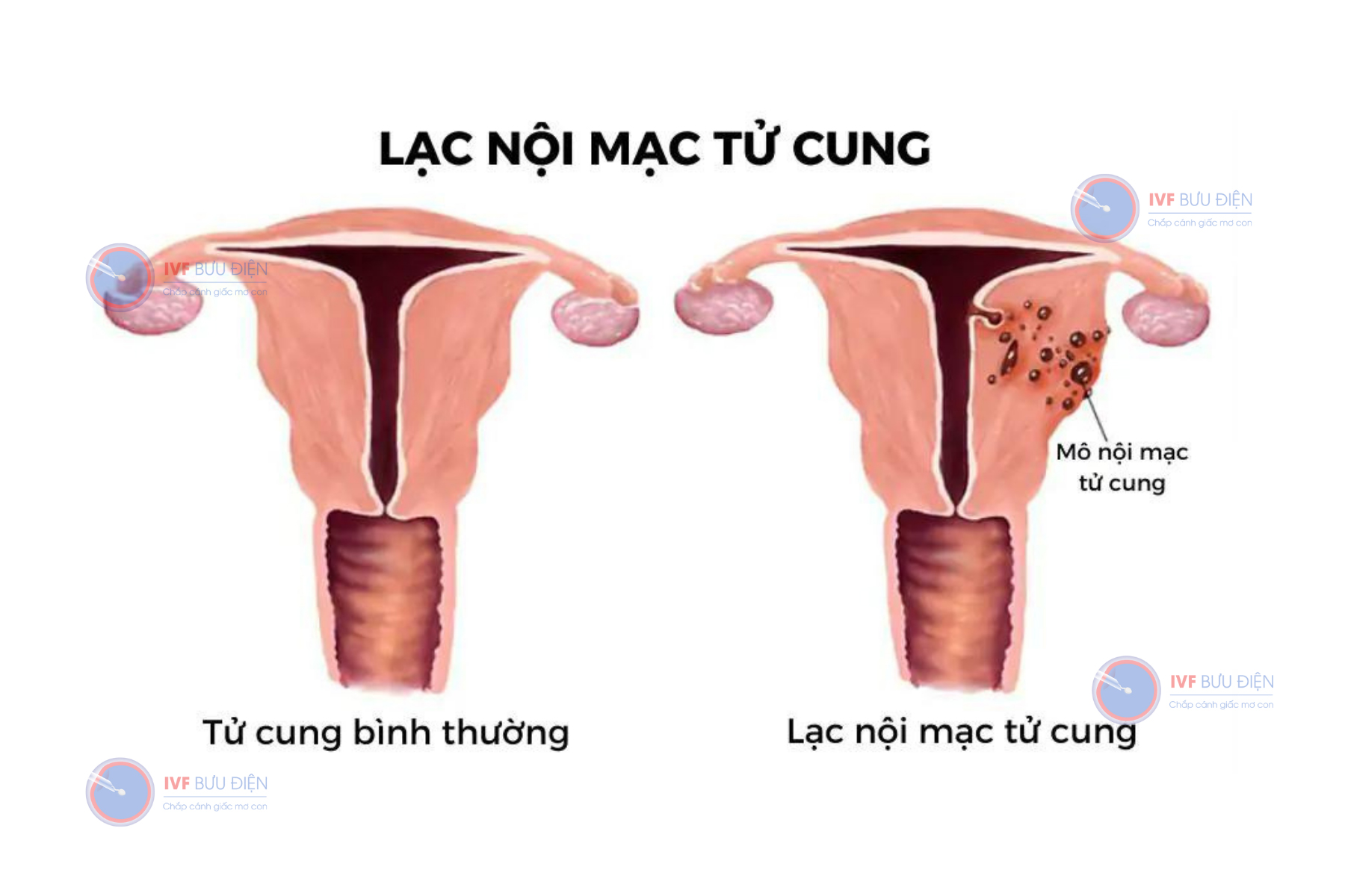 Mỗi người bệnh lạc nội mạc tử cung sẽ có những triệu chứng và mức độ nghiêm trọng khác nhau.