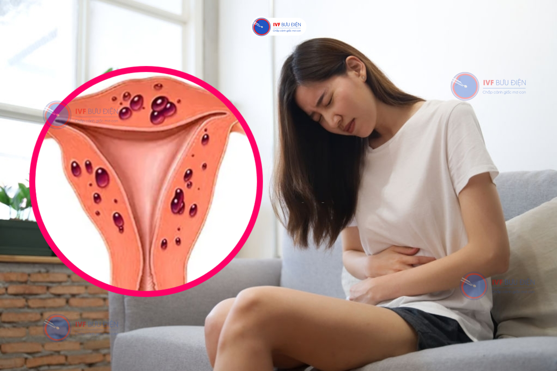 Đau bụng là triệu chứng thường thấy ở những người bị lạc nội mạc tử cung.