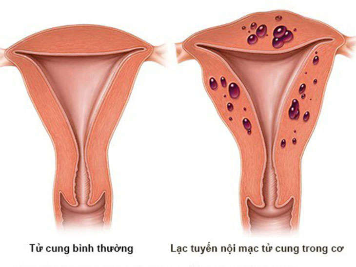 Lạc nội mạc tử cung: Nguyên nhân, chẩn đoán và điều trị