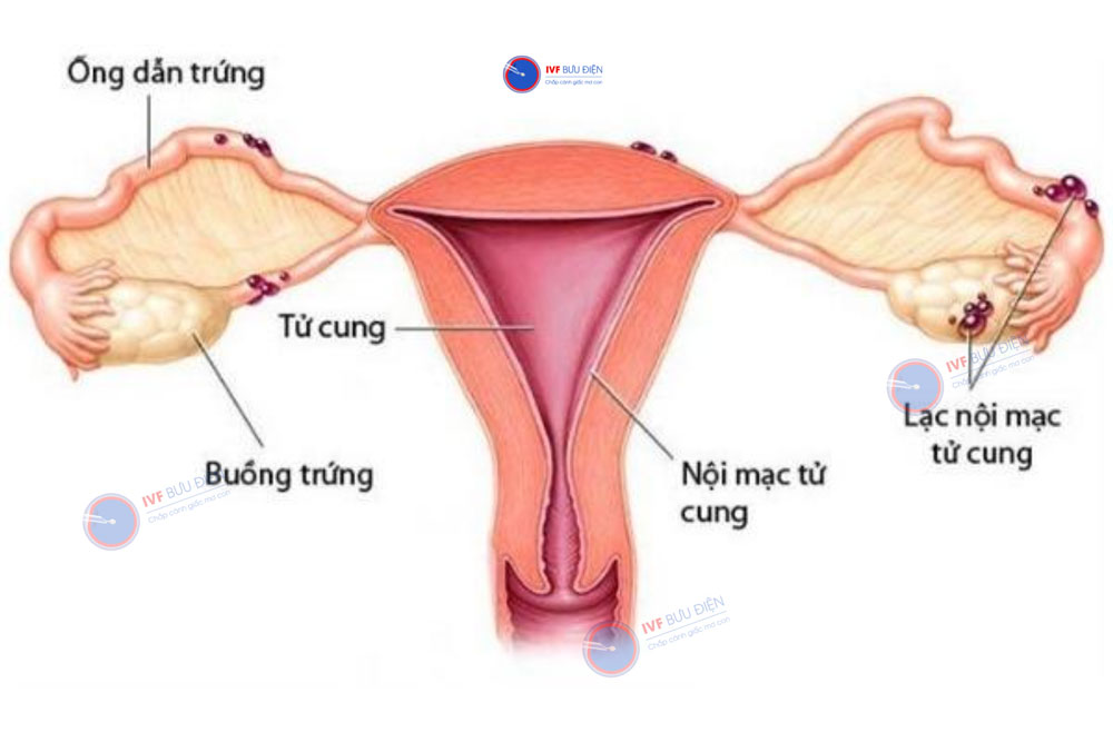 lạc nội mạc tử cung