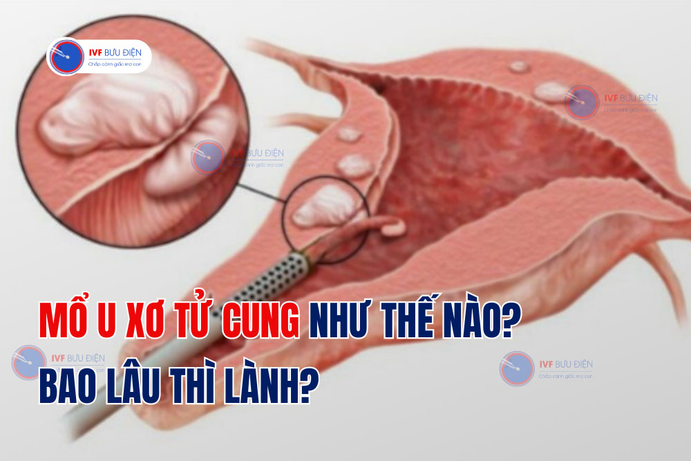 Mổ u xơ tử cung như thế nào? Bao lâu thì lành?