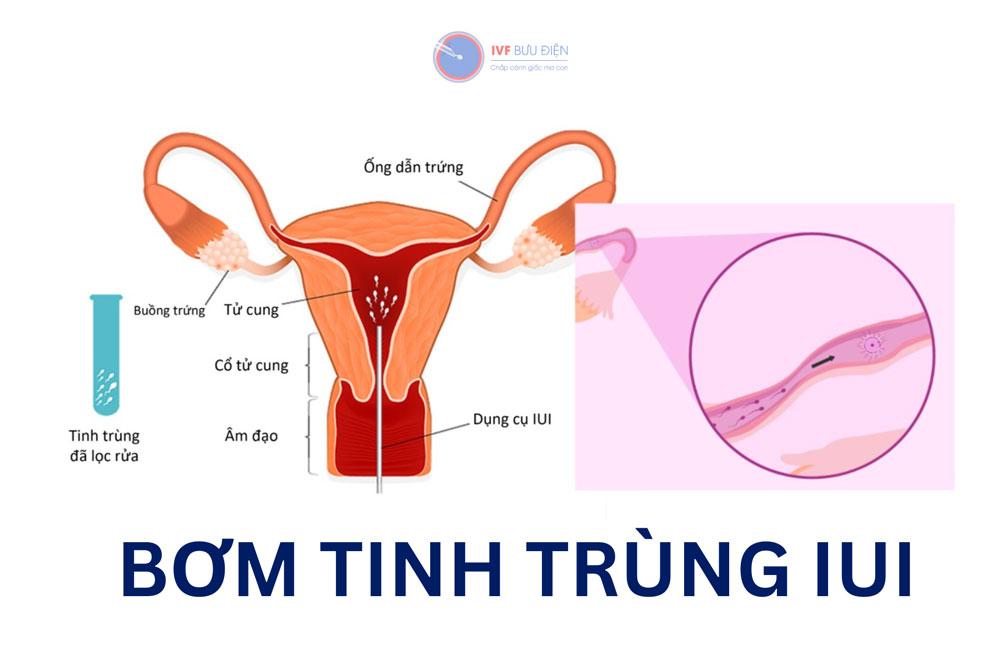 Bơm tinh trùng IUI