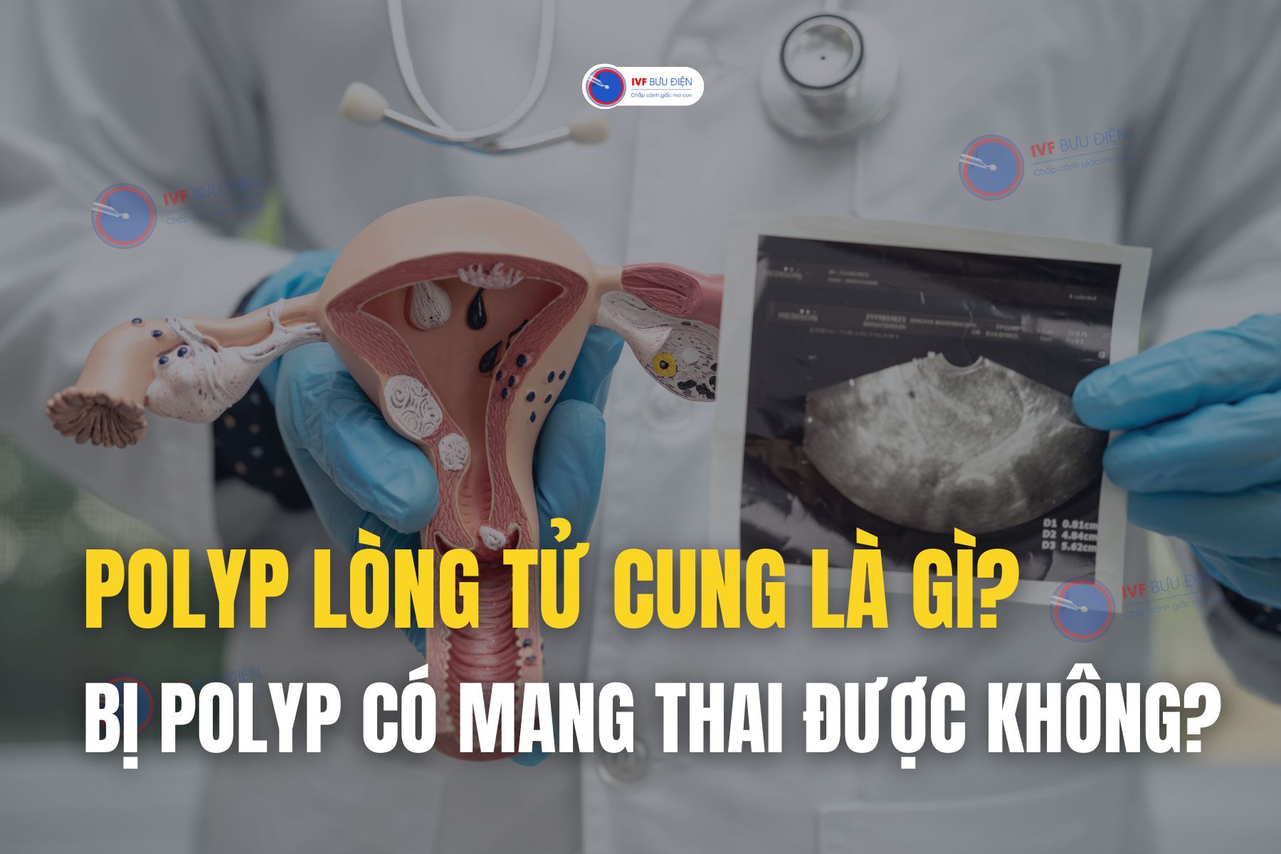 Polyp lòng tử cung là gì? Khi bị có mang thai được không?