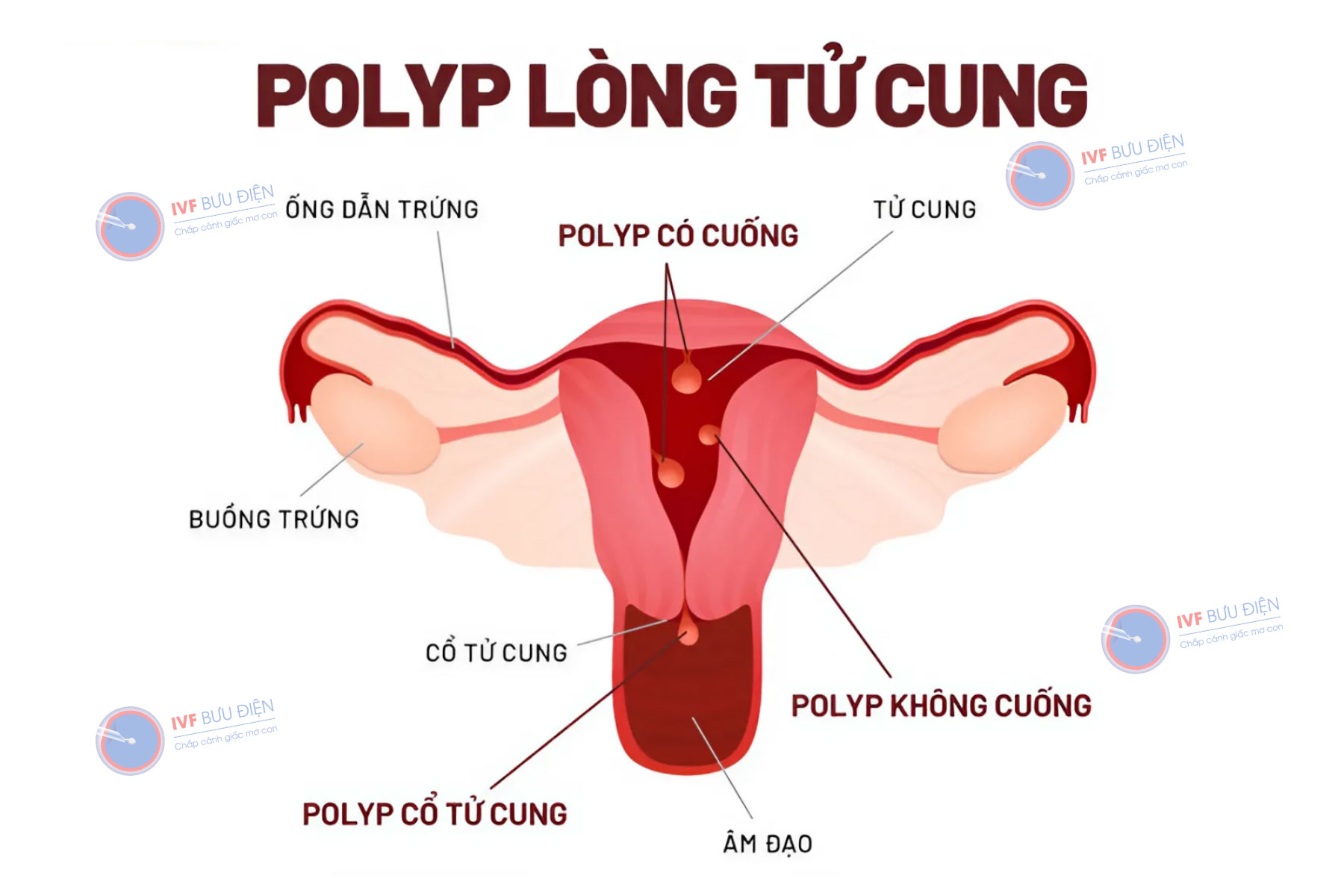 Bị Polyp Tử Cung Có Con Được Không? Giải Đáp và Phương Pháp Điều Trị