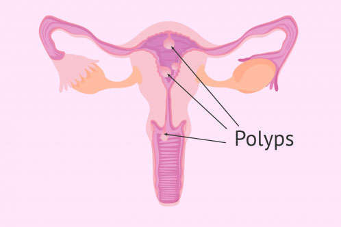 polyp buồng tử cung