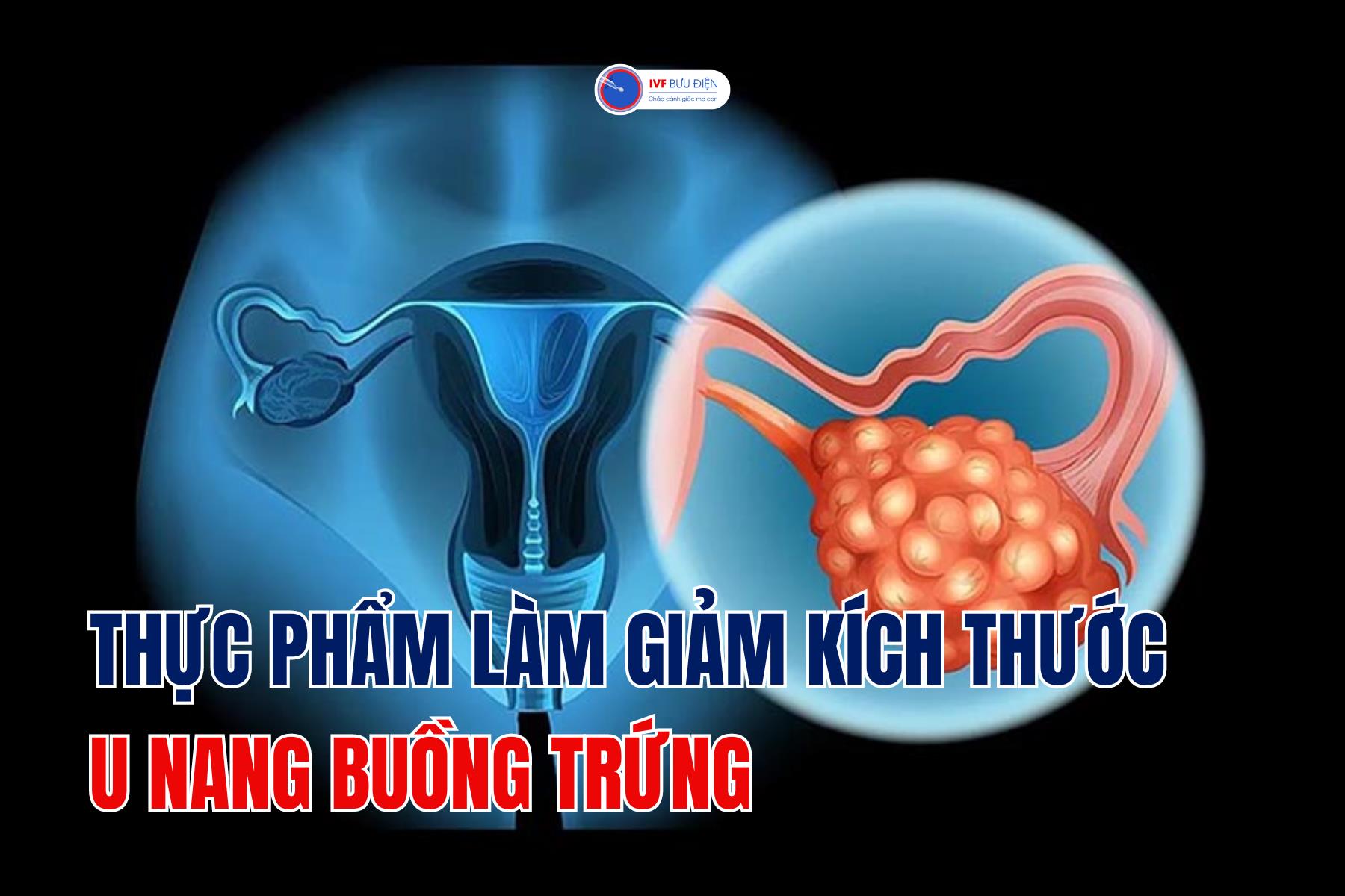 Thực phẩm làm giảm kích thước u nang buồng trứng